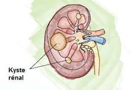 Douleur rein gauche et vessie. Kystes Atypiques Et Tumeurs Kystiques Du Rein
