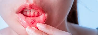 Einige ursachen für geschwollene lippen können jedoch auch schwerwiegender sein. Mundfaule Symptome Behandlung Vorbeugung Mooci