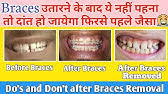 You can use teeth effect bands to close your gap. How To Close Teeth Gap Easily Hindi Fix Midline Diastema Youtube