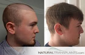 If hair loss is caused by an underlying condition, then treatment of that condition should take complete hair loss on the head is known as alopecia totalis, while complete hair loss on the body is. Body Hair Transplant Hair Transplant Before And After Hair Transplant Hair Loss Remedies Hair Transplant Results