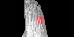 What is a stress fracture and how to avoid it? – Vitalis Physiotherapy