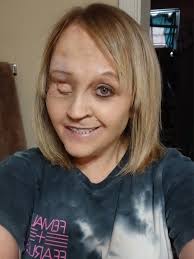 This nf1 pain is no joke