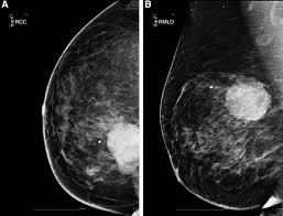 The classification of pt proposed by the world health organization (who) into benign, borderline, and malignant is based on a combination of several histologic features, including stromal cellularity. Malignant Phyllodes Tumor Of The Breast With Liposarcomatous Differentiation A Case Report With Imaging Findings Sciencedirect