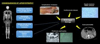 Pagon ra, adam mp, ardinger hh, et al., editors. Lipodystrophy Syndromes Presentation And Treatment Endotext Ncbi Bookshelf