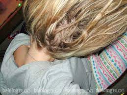 Like other fungal infections, ringworm will weaken the hair follicles, leading to hair shedding. Woman With Tingling Scalp Pain Doctors Can T Find Anything With Photos Wrassman M D Baldingblog