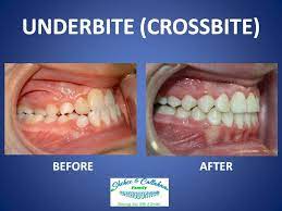 In jaw realignment surgery, for adults or children, the jaw is broken and repositioned. How To Fix A Crossbite With Invisalign