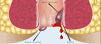 Tokeo la picha la haemorrhoids