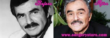 Usually, men do not really concern about their looks, so they do not get plastic surgery issue very often. Burt Reynolds Plastic Surgery Before After Pic