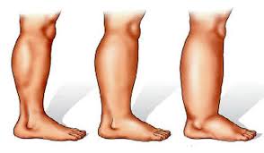 The Best 16 Natural Home Remedies For Swollen Legs Remedios Para Pies Retencion De Agua Linfatico