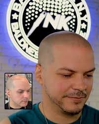 Expert Scalp Micropigmentation in NYC