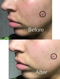 REVIEW] L'Oréal Blue Clay Mask Clear and Comfort (Before and After) —  DEWILDESALHAB武士