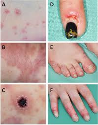 Image result for Vasculitis