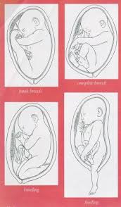 Image result for Breech Delivery