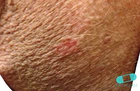 Guia De La Piel Psoriasis Genital