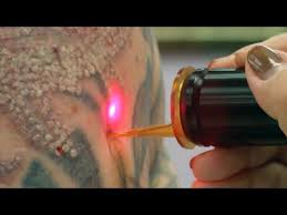We are the leading provider of cosmetic laser tattoo removal procedures in the region. Fast Tattoo Removal Seattle Bizatomic