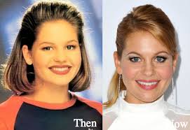 candace-cameron-chin-implants