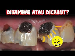 Rawatan scaling gigi klinik pergigian erfa kl terbaik laa. Yang Benar Gigi Bolong Dicabut Atau Ditambal A Z Perawatan Gigi Youtube