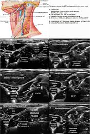 Image result for Superior Trunk Block