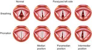 Recent examples on the web these big, open passages inside the mouth cavity, namely the glottis and the eustachian tubes, allow sound to pass. Unilateral Vocal Fold Immobility Ento Key