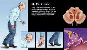 There are dozens of parkinson's disease symptoms, and they vary by individual. M Parkinson Fruhsymptome Und Differentialdiagnostik