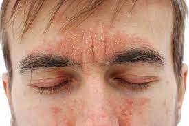 Der seborrhoisches ekzem gesicht creme test hat herausgestellt, dass die qualitätsstufe des verglichenen testsiegers im test besonders herausgeragt hat. Neurodermitis Im Gesicht Ihr Ratgeber Volksversand Versandapotheke
