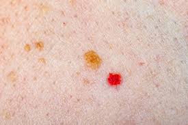 Multiple angioma growths adjoining each other are collectively known as polyploid. Red Spots On Skin Causes Diagnosis And Treatments