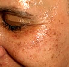 Brown spot appeared on wrist, top of hand and back of arm. 21 Best Essential Oils For Age Spots On Face And Hands Essential Oil Benefits