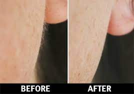 While its purpose is to thermally protect the body by insulation and cooling through perspiration, it is okay to remove facial vellus hair. Vellus Hair Peach Fuzz Hair Removal In Nyc