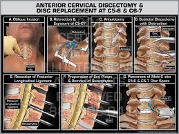 Anterior Cervical Discectomy Disc Replacement At C5 6 C6 7 Print Quality Instant Download Cervical Cervical Spinal Stenosis Herniated Disc