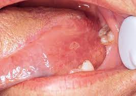 What Causes Mouth Sores Oral Health Aspen Dental