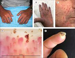 Systemic Sclerosis Associated Interstitial Lung Disease The Lancet Respiratory Medicine