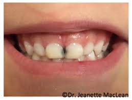 After i'd gotten passport photos taken, filled out the forms, etc. Sdf Pediatric Dentistry S New Silver Bullet Pediatric Dental Blog