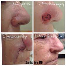 If breast cancer is diagnosed at an early enough stage, it's treatable. Everything You Need To Know About Skin Cancer Dr Pimple Popper