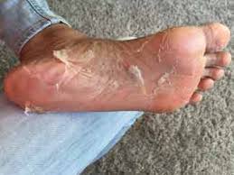Aprende Por Que Se Pelan Los Pies Conoce Las Posibles Razones Meganotas