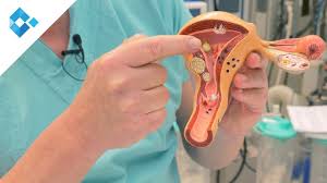 Ancak abortus (düşük) insidansı 2 misli artmıştır, erken gebelik kanamalarına neden olabilir. Myome Diagnose Behandlung Schwangerschaft Mit Einem Myom Oa Dr Schauer Youtube