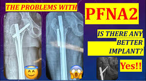 Problems with PFN: is TFNA a solution for trochanteric fractures in old