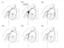 Image result for Breast Cancer Staging
