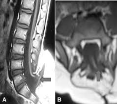 Image result for Spinal Dysraphism