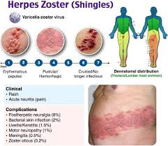 Image result for herpes zoster