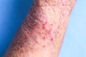 27 Skin Soothing Tips And Products People With Eczema Swear By