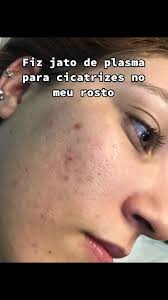 Jato De Plasma Processo De Cicatrização