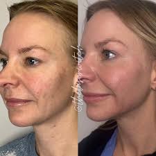 Who needs a scalpel when you've got a laser this powerful? ✨ . . This  transformation was achieved using ProFractional laser only. One session! ✨  Notice the smoother texture, softened lines, and