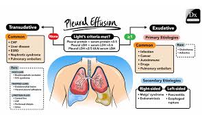 But if the pericardium is diseased or injured, the resulting inflammation can lead to excess fluid. Pleural Effusion Diagnostic Schema From The Clinical Problem Solvers Tom Wade Md