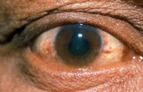 Image result for Ciliary Flush