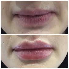 When the lips are injected, the upper lip tends to swell much more than the lower lip and often patients think that their upper lip has had too much filler injected into it. Lip Augmentation The Bradford Clinic