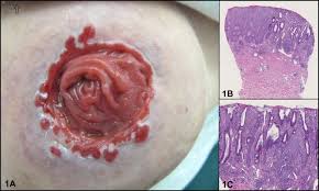 Check spelling or type a new query. Peristomal Granulation Tissue Like Papules Journal Of The American Academy Of Dermatology