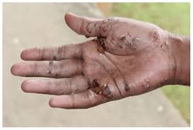 Image result for scabies human children