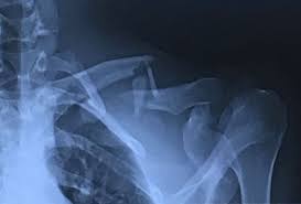 Digit imaging requires diligent positioning. Clavicle Fracture Treatment When Is Surgery Necessary