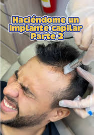 Implante Capilar: Mi Experiencia y Evolución Pt. 2