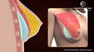 Breast implant brands & types at feel beautiful in san diego. Breast Implants Sydney Breast Augmentation Australia Dr Eddy Dona